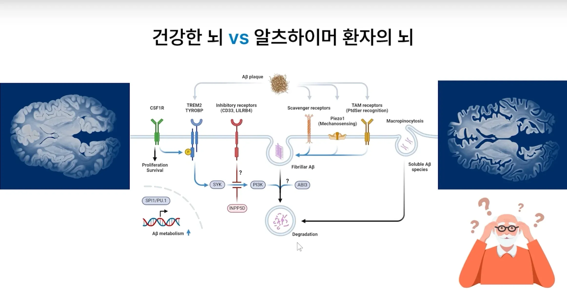 건강한 뇌와 알츠하이머 환자의 뇌를 비교하는 강의 화면